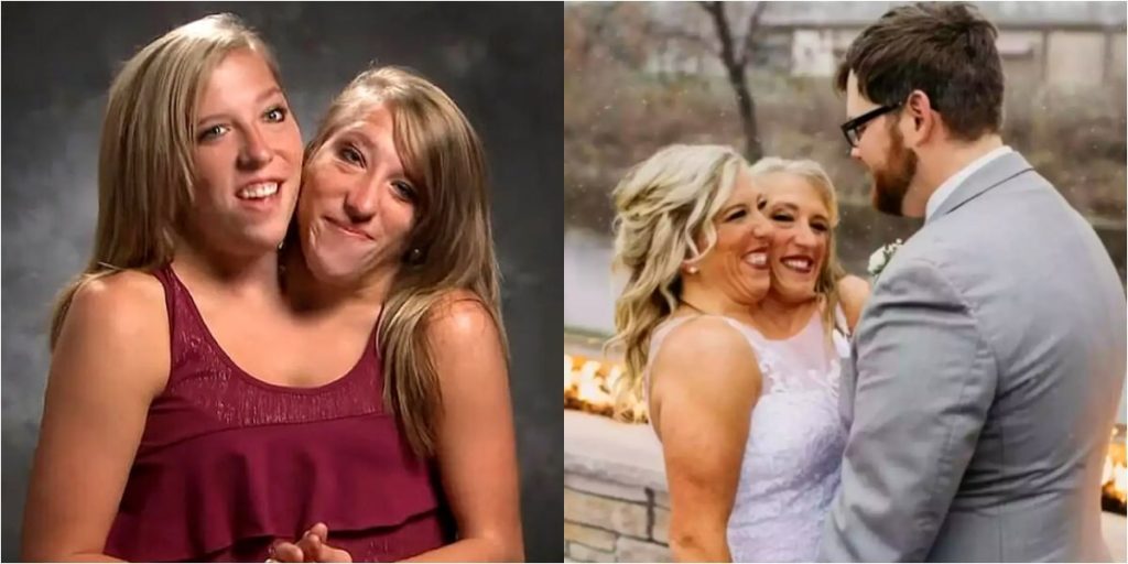 Popular American Conjoined Twin Gets Married – The News Desk